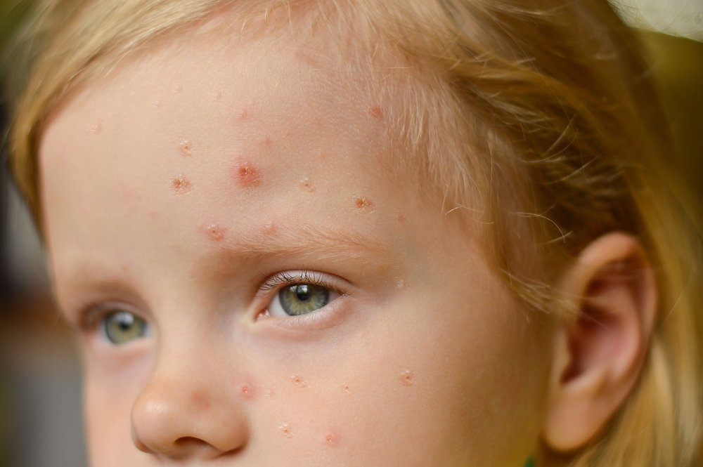 Treatment of monkeypox in children